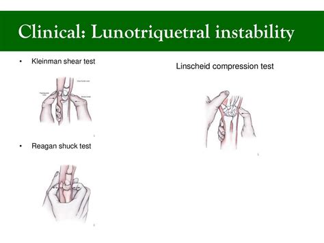 lunotriquetral compression test|lunotriquetral dissociation test.